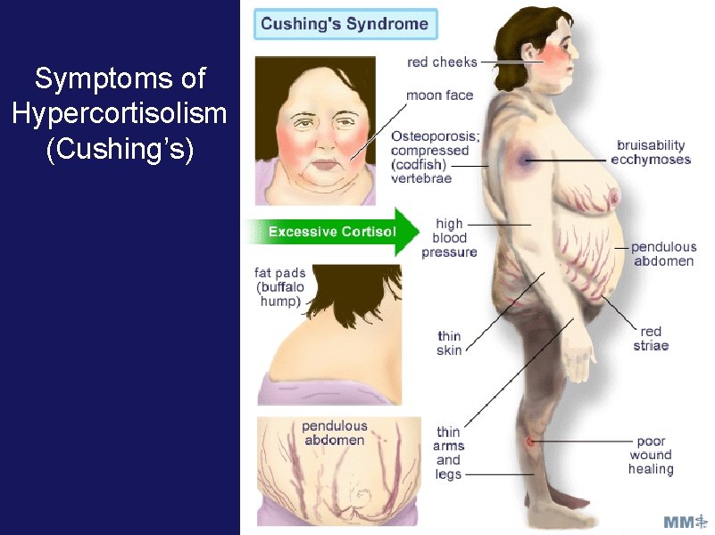 Symptoms of Hypercortisolism (Cushing’s) Symptoms of Hypercortisolism (Cushing’s)
