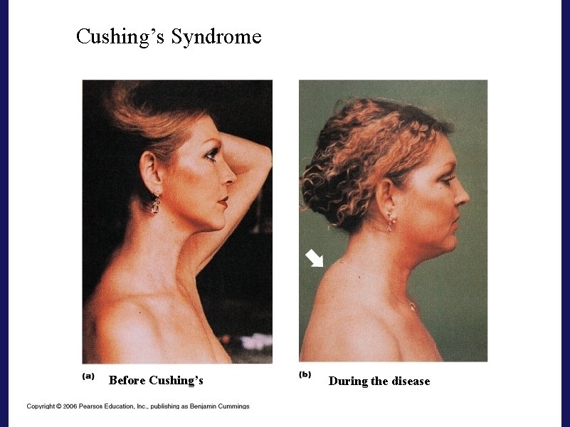 Cushing’s Syndrome Before Cushing’s During the disease Cushing’s Syndrome Before Cushing’s During the disease