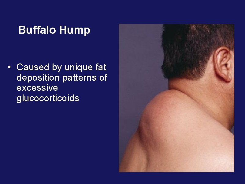Buffalo Hump • Caused by unique fat deposition patterns of excessive glucocorticoids Buffalo Hump • Caused by unique fat deposition patterns of excessive glucocorticoids