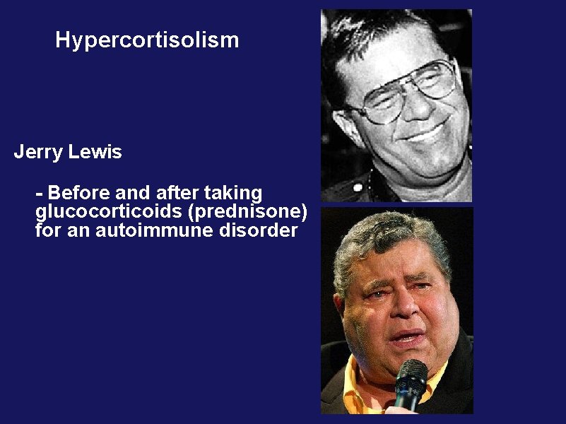 Hypercortisolism Jerry Lewis - Before and after taking glucocorticoids (prednisone) for an autoimmune disorder Hypercortisolism Jerry Lewis - Before and after taking glucocorticoids (prednisone) for an autoimmune disorder