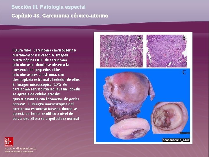 Sección III. Patología especial Capítulo 48. Carcinoma cérvico-uterino Figura 48 -4. Carcinoma cervicouterino microinvasor