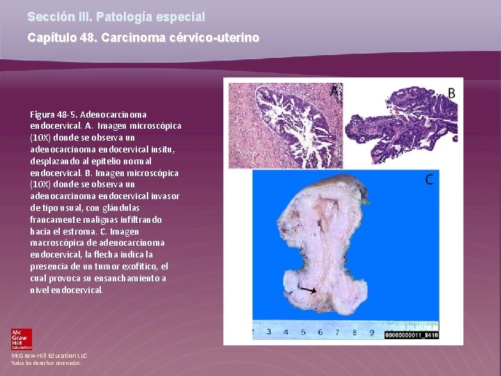Sección III. Patología especial Capítulo 48. Carcinoma cérvico-uterino Figura 48 -5. Adenocarcinoma endocervical. A.