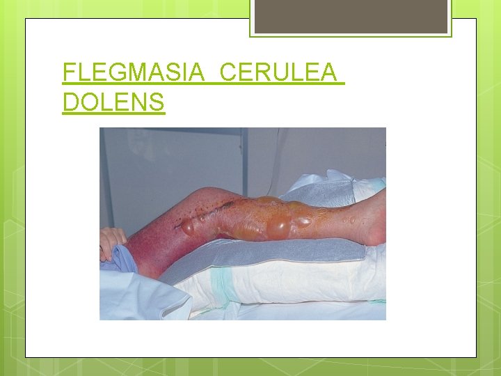 FLEGMASIA CERULEA DOLENS 
