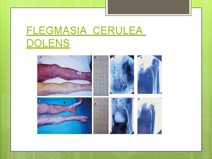 FLEGMASIA CERULEA DOLENS 