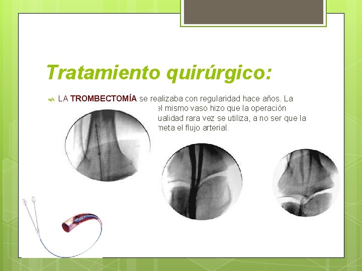 Tratamiento quirúrgico: LA TROMBECTOMÍA se realizaba con regularidad hace años. La recidiva de la