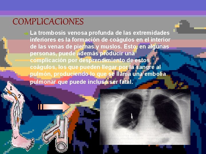 COMPLICACIONES La trombosis venosa profunda de las extremidades inferiores es la formación de coágulos