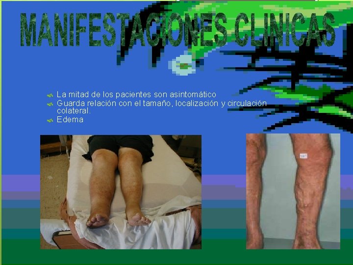  La mitad de los pacientes son asintomático Guarda relación con el tamaño, localización
