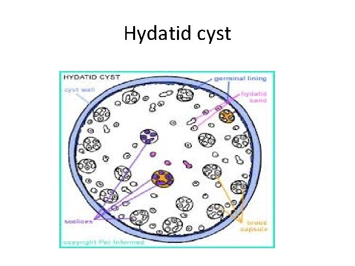 Hydatid cyst 