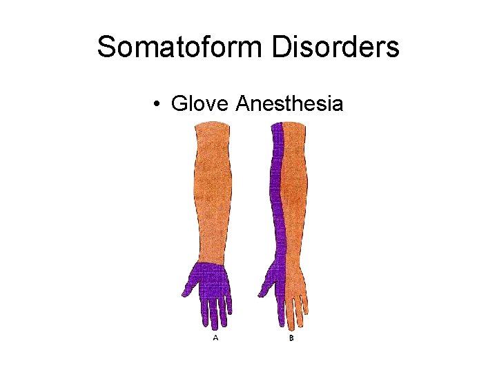 Somatoform Disorders • Glove Anesthesia 