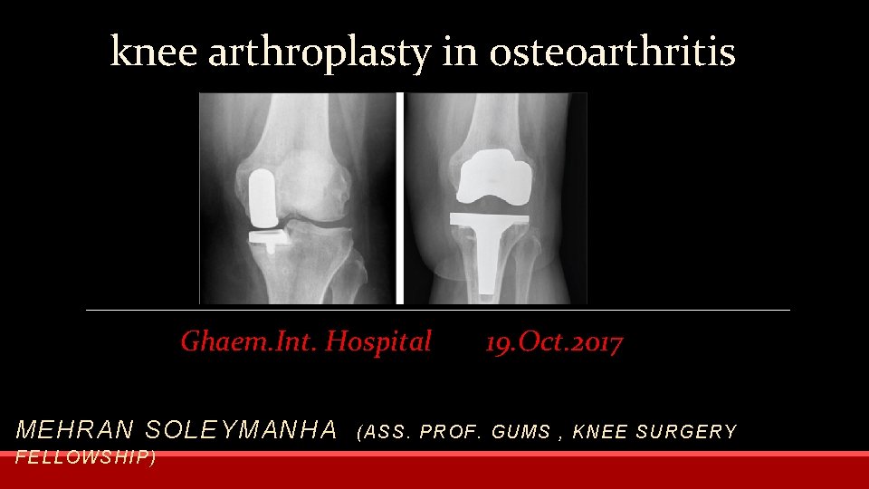 knee arthroplasty in osteoarthritis Ghaem. Int. Hospital MEHRAN SOLEYMANHA FELLO WS HIP) 19. Oct.