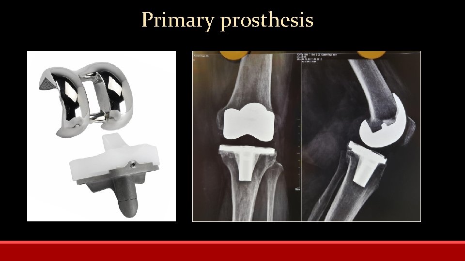 Primary prosthesis 