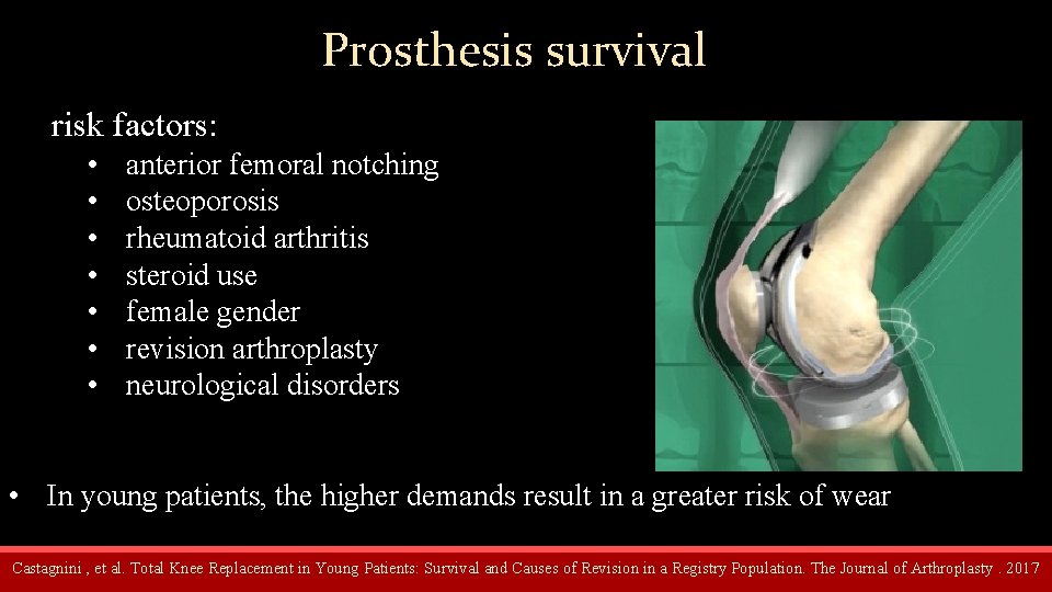 Prosthesis survival risk factors: • • anterior femoral notching osteoporosis rheumatoid arthritis steroid use