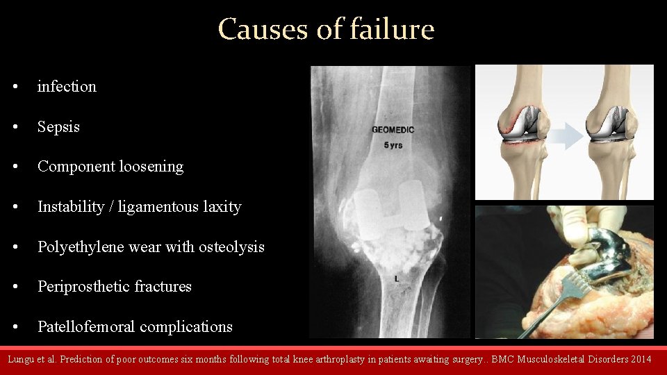 Causes of failure • infection • Sepsis • Component loosening • Instability / ligamentous
