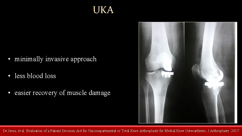 UKA • minimally invasive approach • less blood loss • easier recovery of muscle