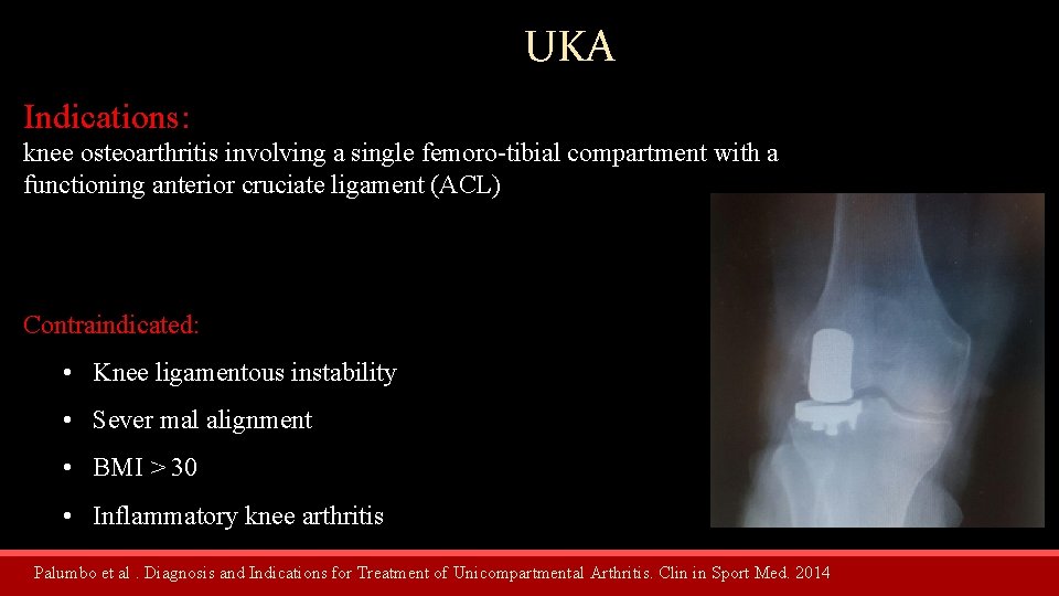 UKA Indications: knee osteoarthritis involving a single femoro-tibial compartment with a functioning anterior cruciate