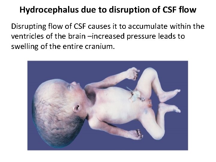 Hydrocephalus due to disruption of CSF flow Disrupting flow of CSF causes it to Hydrocephalus due to disruption of CSF flow Disrupting flow of CSF causes it to