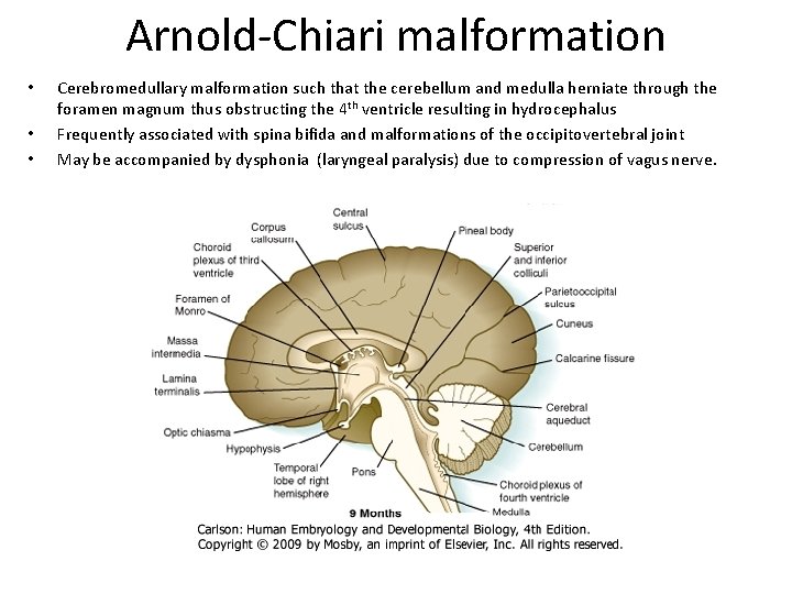 Arnold-Chiari malformation • • • Cerebromedullary malformation such that the cerebellum and medulla herniate Arnold-Chiari malformation • • • Cerebromedullary malformation such that the cerebellum and medulla herniate