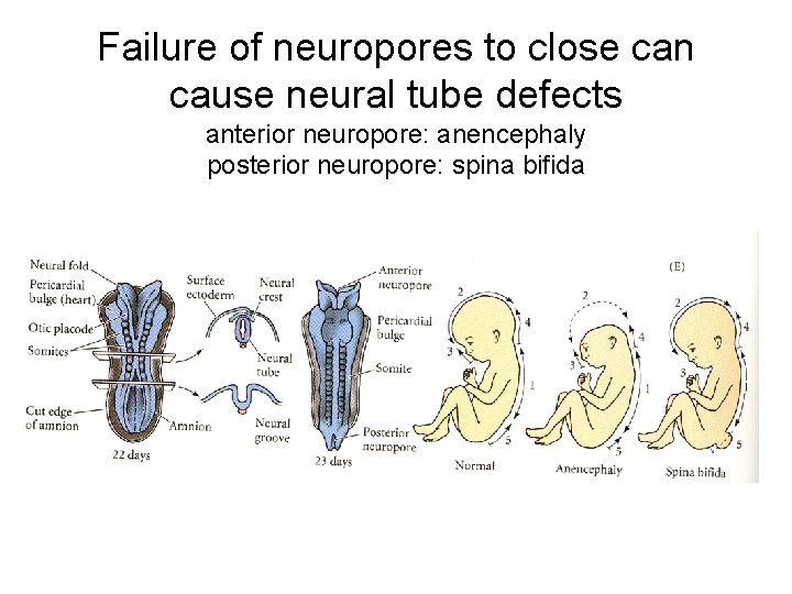 Failure of neuropores to close can cause neural tube defects anterior neuropore: anencephaly posterior Failure of neuropores to close can cause neural tube defects anterior neuropore: anencephaly posterior