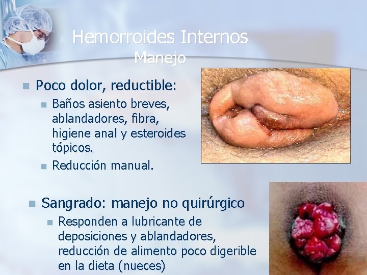 Hemorroides Internos Manejo n Poco dolor, reductible: n n n Baños asiento breves, ablandadores,