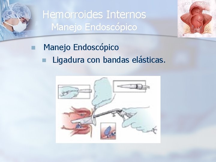 Hemorroides Internos Manejo Endoscópico n Ligadura con bandas elásticas. 