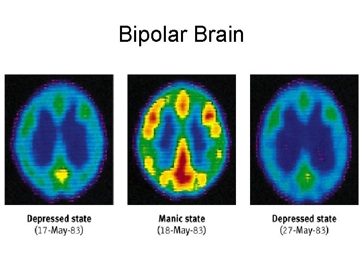 Bipolar Brain Bipolar Brain
