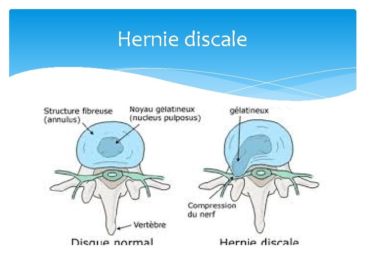 Hernie discale 