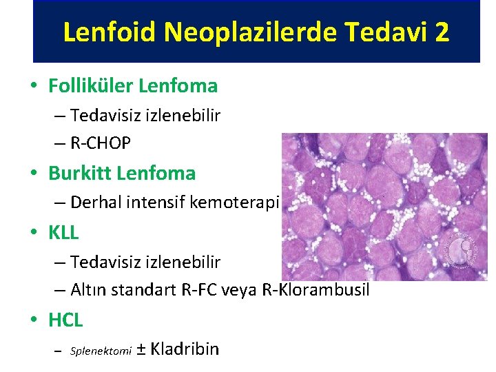 Lenfoid Neoplazilerde Tedavi 2 Lenfoma Tedavisi: 2 • Folliküler Lenfoma – Tedavisiz izlenebilir –