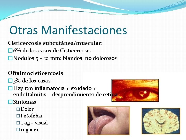 Otras Manifestaciones Cisticercosis subcutánea/muscular: � 6% de los casos de Cisticercosis �Nódulos 5 –