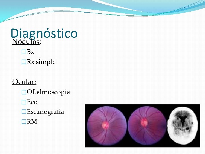 Diagnóstico Nódulos: �Bx �Rx simple Ocular: �Oftalmoscopia �Eco �Escanografía �RM 
