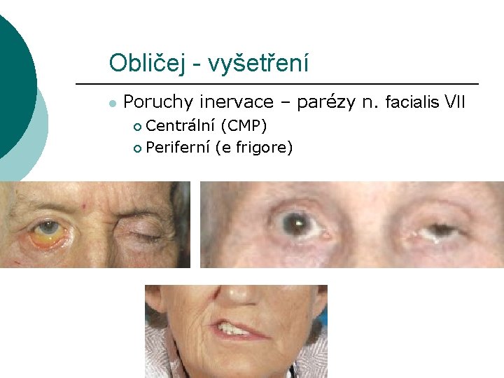 Obličej - vyšetření l Poruchy inervace – parézy n. facialis VII Centrální (CMP) ¡