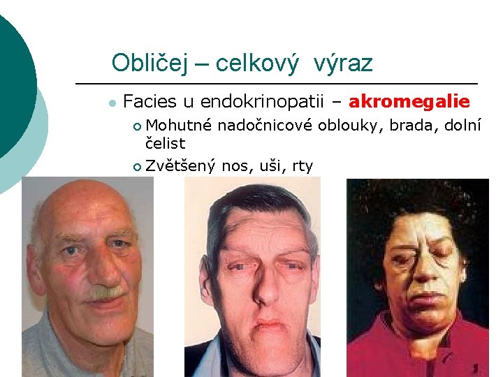 Obličej – celkový výraz l Facies u endokrinopatii – akromegalie Mohutné nadočnicové oblouky, brada,