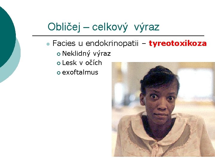 Obličej – celkový výraz l Facies u endokrinopatii – tyreotoxikoza Neklidný výraz ¡ Lesk