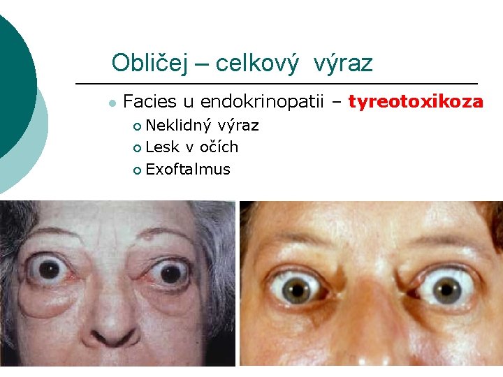 Obličej – celkový výraz l Facies u endokrinopatii – tyreotoxikoza Neklidný výraz ¡ Lesk