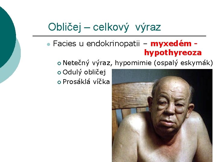 Obličej – celkový výraz l Facies u endokrinopatii – myxedém hypothyreoza Netečný výraz, hypomimie