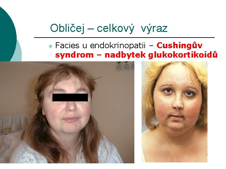 Obličej – celkový výraz l Facies u endokrinopatii – Cushingův syndrom – nadbytek glukokortikoidů