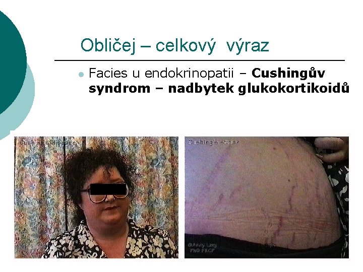 Obličej – celkový výraz l Facies u endokrinopatii – Cushingův syndrom – nadbytek glukokortikoidů