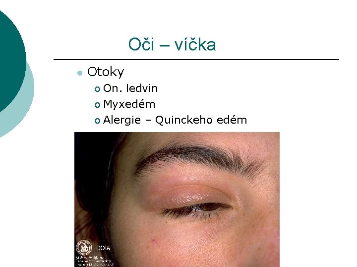 Oči – víčka l Otoky On. ledvin ¡ Myxedém ¡ Alergie – Quinckeho edém