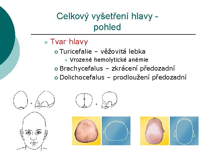 Celkový vyšetření hlavy - pohled l Tvar hlavy ¡ Turicefalie – věžovitá lebka l