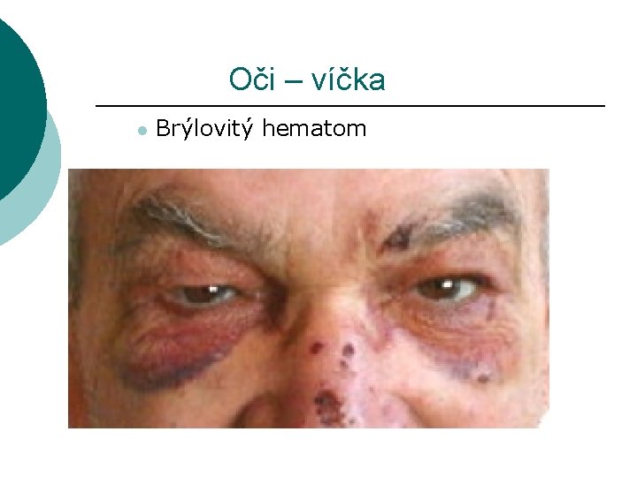 Oči – víčka l Brýlovitý hematom 