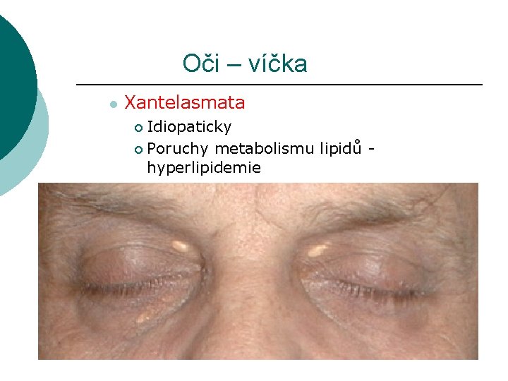 Oči – víčka l Xantelasmata Idiopaticky ¡ Poruchy metabolismu lipidů - hyperlipidemie ¡ 