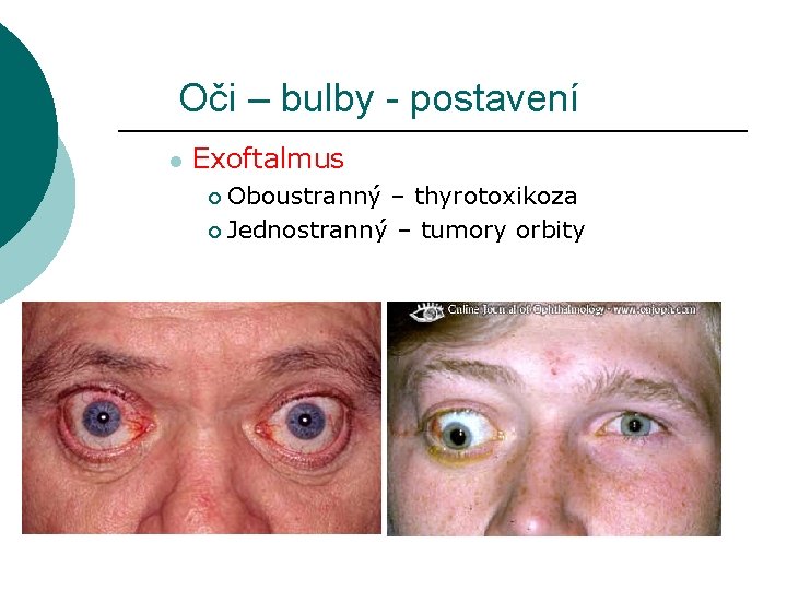 Oči – bulby - postavení l Exoftalmus Oboustranný – thyrotoxikoza ¡ Jednostranný – tumory