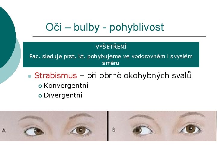 Oči – bulby - pohyblivost VYŠETŘENÍ Pac. sleduje prst, kt. pohybujeme ve vodorovném i