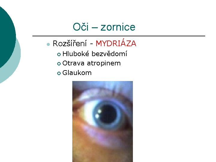 Oči – zornice l Rozšíření - MYDRIÁZA Hluboké bezvědomí ¡ Otrava atropinem ¡ Glaukom