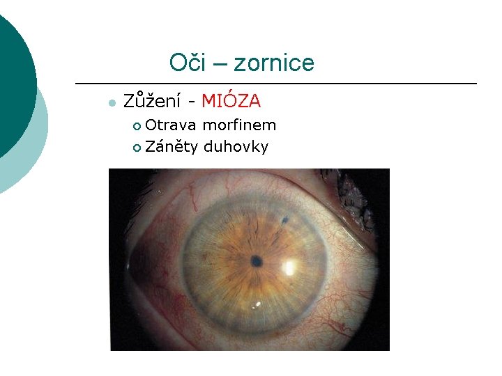 Oči – zornice l Zůžení - MIÓZA Otrava morfinem ¡ Záněty duhovky ¡ 