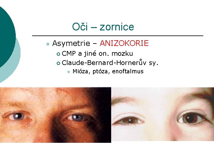 Oči – zornice l Asymetrie – ANIZOKORIE CMP a jiné on. mozku ¡ Claude-Bernard-Hornerův