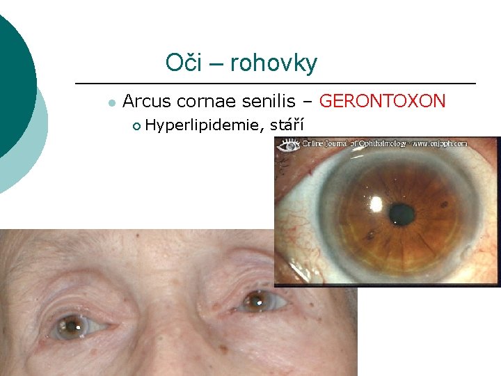 Oči – rohovky l Arcus cornae senilis – GERONTOXON ¡ Hyperlipidemie, stáří 