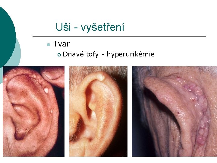 Uši - vyšetření l Tvar ¡ Dnavé tofy - hyperurikémie 
