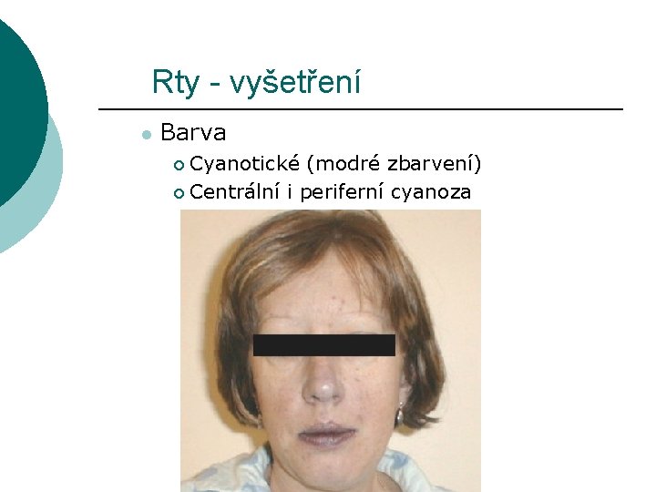 Rty - vyšetření l Barva Cyanotické (modré zbarvení) ¡ Centrální i periferní cyanoza ¡