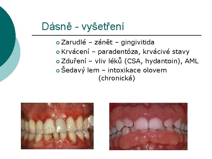 Dásně - vyšetření Zarudlé – zánět – gingivitida ¡ Krvácení – paradentóza, krvácivé stavy