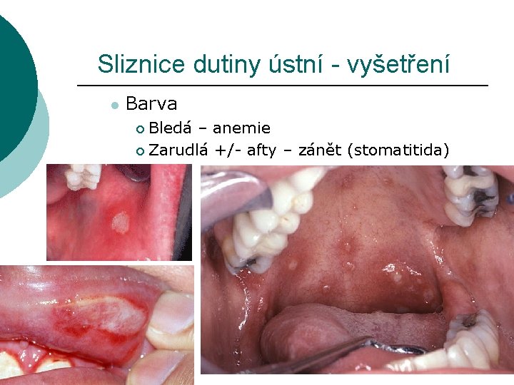 Sliznice dutiny ústní - vyšetření l Barva Bledá – anemie ¡ Zarudlá +/- afty